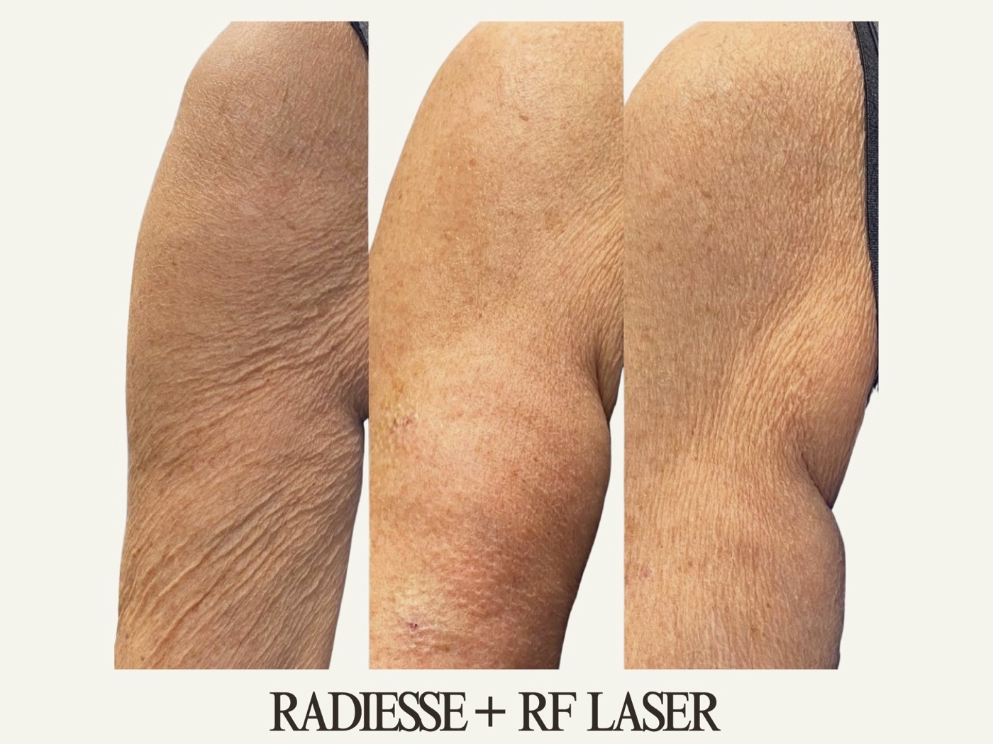 Powell Studio Arms before and after