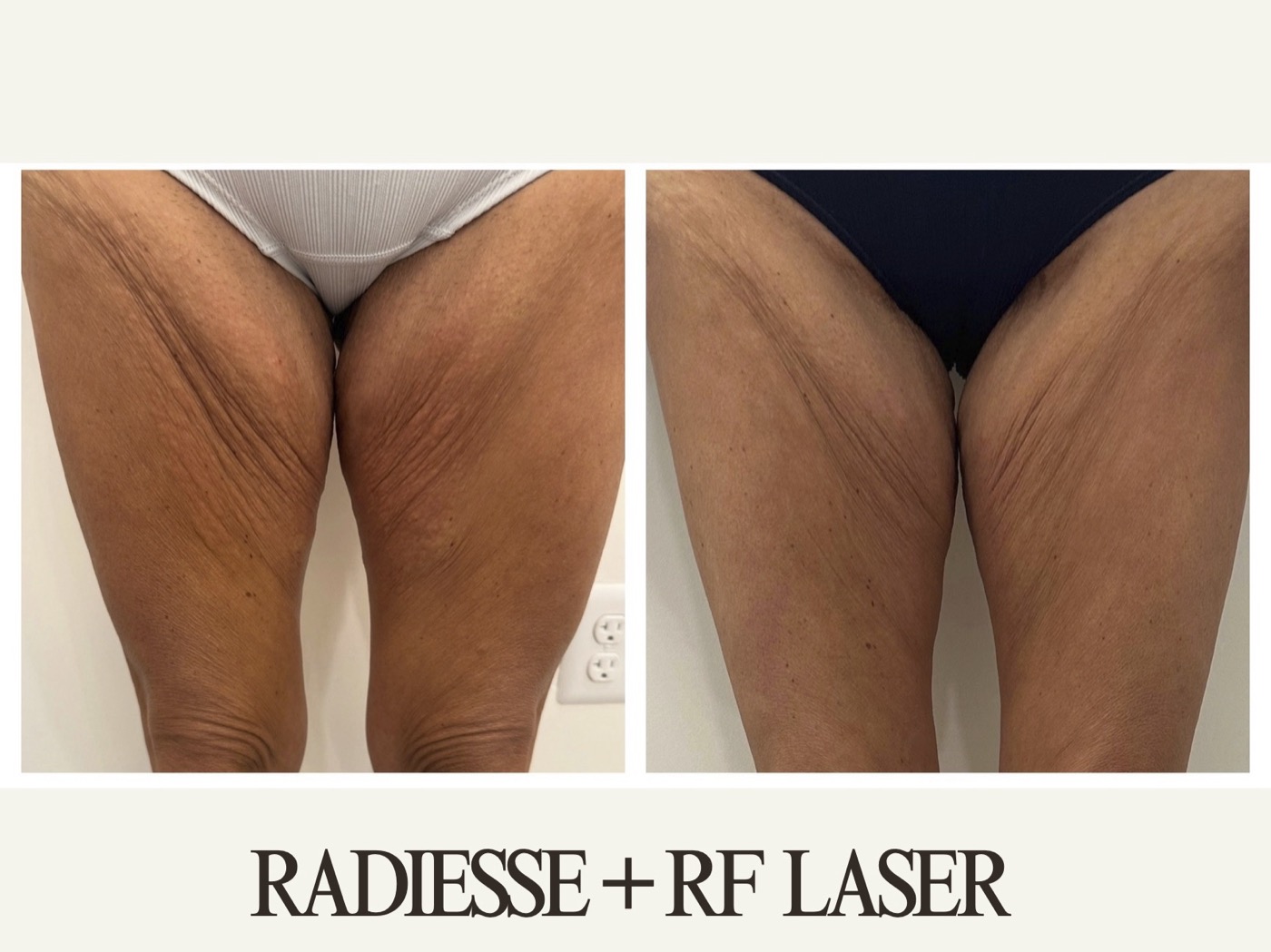 Powell Studio Legs & thighs before and after
