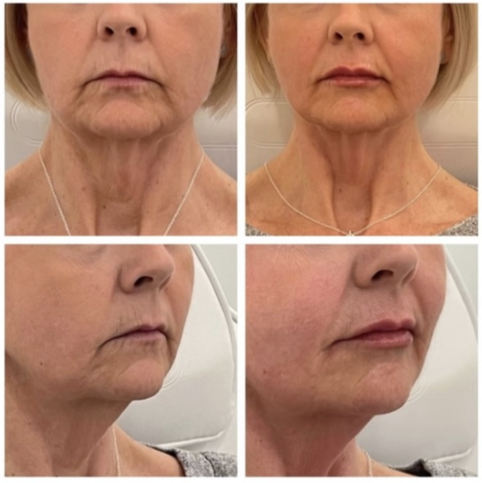 Signature Lips before and after 5