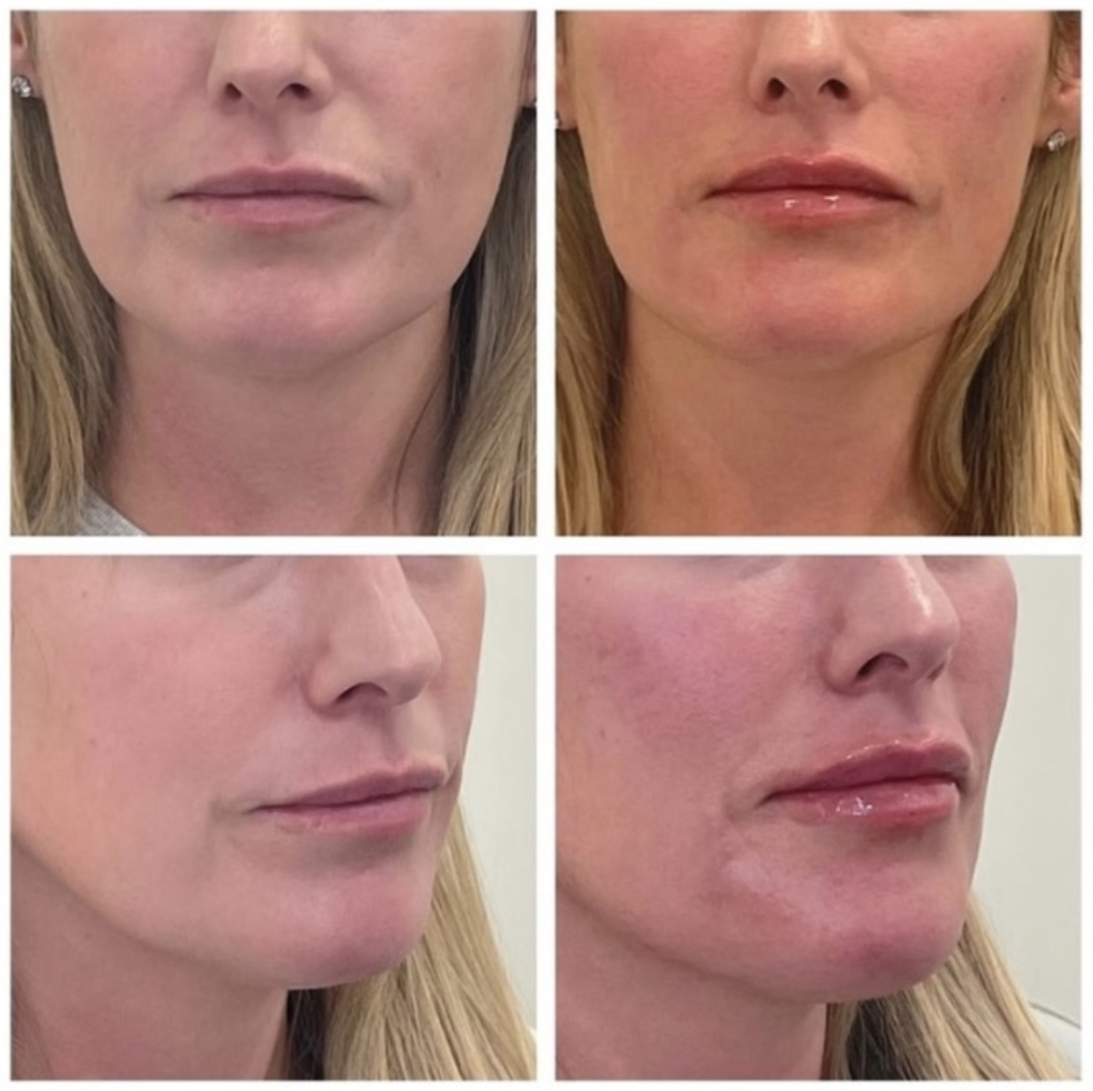 Signature Lips before and after 6